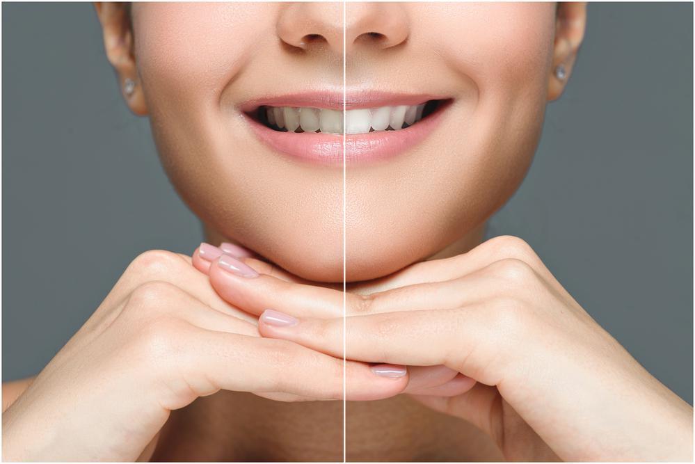 Teeth Whitenings Teeth Whitenings